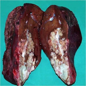 Лечение на черен дроб как да се отнасяме, какво и как да се отнасяме черен дроб