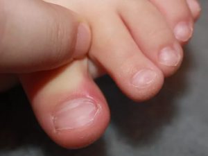 За лечение на врастнали нокти у дома