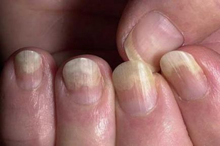 лечение на онихомикоза на ноктите