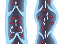 Какво е lymphostasis крака