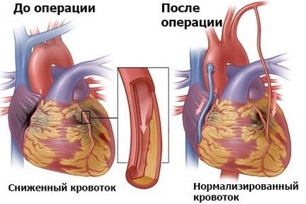 Коронарен байпас какво е