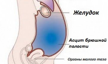 От което течността в корема