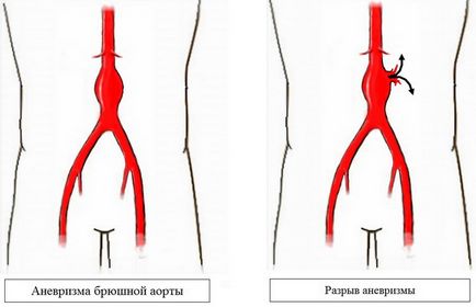 Атеросклерозата на аортата, че е