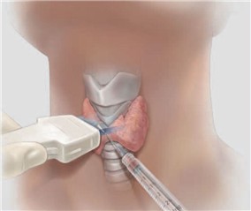 Игла биопсия на щитовидната жлеза