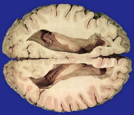Камерни дилатация (наляво, надясно, страна) на мозъка