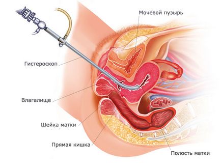 Hysteroresectoscopy какво е