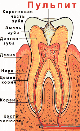 Какво е лечението на пулпит