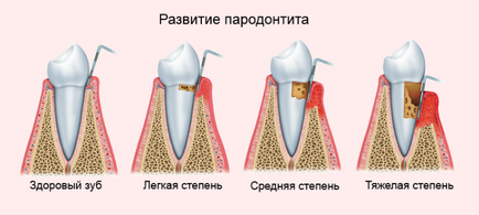 Пародонтит медицинска история