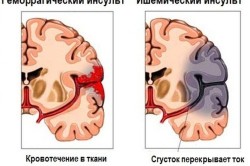 Ход при мъжете