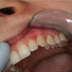 Как да се отървем от кървене на венците
