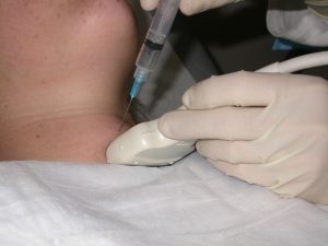 Игла биопсия на щитовидната жлеза
