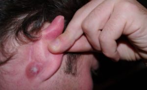 Лечение на възпаление на лимфните възли зад ухото