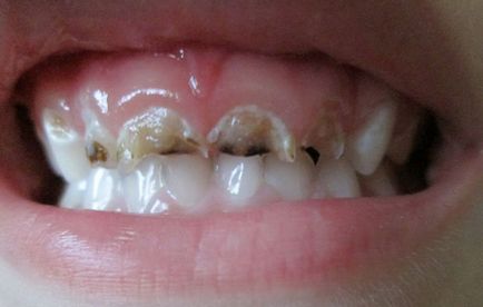 Какво се разпада зъби по време на сън