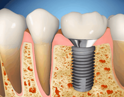зъби Inplontanty какво е