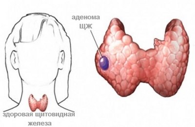 Щитовидната жлеза аденом причини, симптоми, лечение