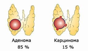 Щитовидната жлеза аденом причини, симптоми, лечение