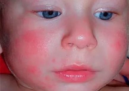 Алергия към ябълки в детето и възрастни симптоми и лечение