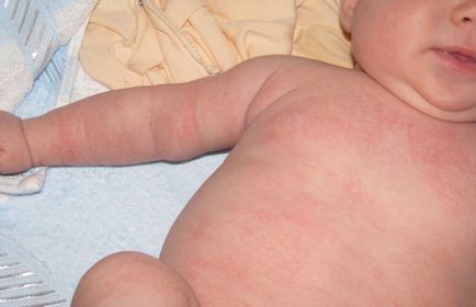 Алергия при новородено изглежда, какво да правя, отколкото за лечение на принципите на лечение при кърмачета