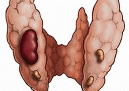 Какво е щитовидната жлеза аденом и какви са симптомите