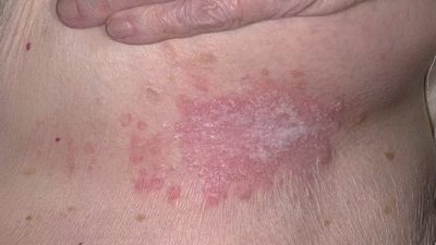 Гъбична инфекция на кожата при лечение на жени и симптоми