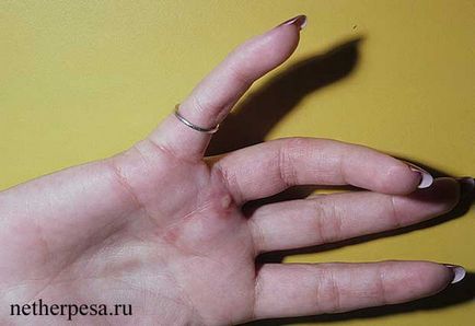 Херпес на ръцете диагноза, симптоми, лечение