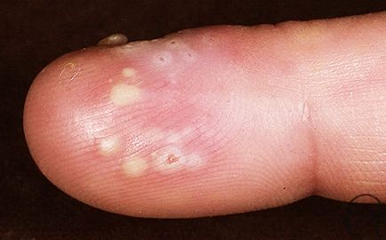 Херпес на ръцете и пръстите - причини, симптоми и лечение (снимка)