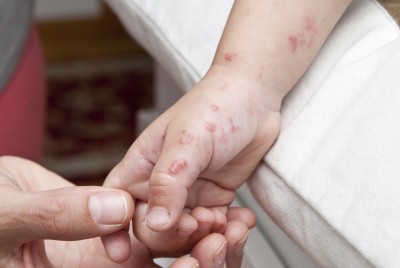 Херпес на ръцете лечения, причини и симптоми на вируса