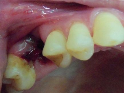 Колко дълго дупка лекува венците след вадене на зъб, тъй като може да излекува раната лечебни процеси