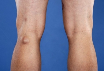 кисти на колянната става Бейкър - за домашно лечение народни средства