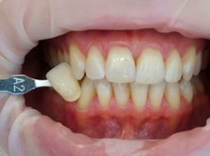 избелване на зъбите Laser - какво е това, мнения, цени, снимки е преди и след