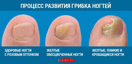 Повечето ефективни национални методи за лечение на гъбички на ноктите