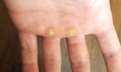 Calluses на ръцете причини за симптомите, признаци лечението и диагностиката