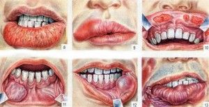 От вътрешната страна на долната устна се появи предизвиква бум