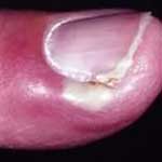 Един абсцес на пръста си - какво да се прави - народната медицина лечение на абсцеси