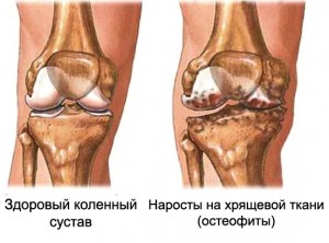 Диагнозата на коляното остеофити и лечението