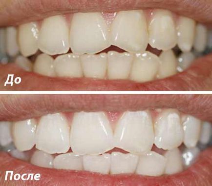 Избелване на зъби снимки преди и след