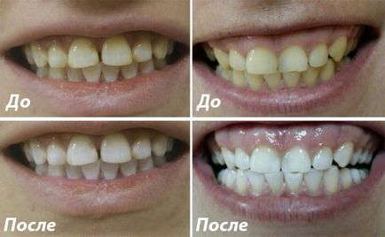 Избелване на зъби снимки преди и след