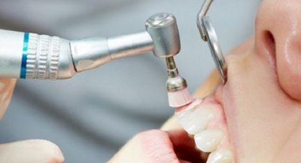 полиране на зъби - снимка преди и след, цени за полиране и шлифоване на зъбите - Стоматологичен портал