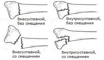 Признаци пръст фрактура на крака си