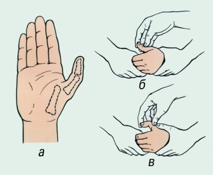 Признаци пръст фрактура на ръката си
