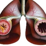 Производство и непродуктивна кашлица причини и лечение