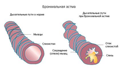 ПСВ, ФЕО1 при астма какво е норма, оценяването