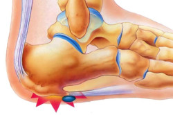 Heel стимул предизвиква симптомите и лечението