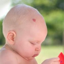 Рождените белези при новородени причинява на, вид, предпазни мерки