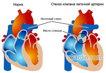 Шум на сърцето при възрастни води, видове, симптоми и лечение