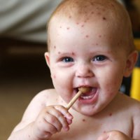 Детето има варицела какво да се прави бързо лечение на варицела