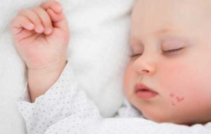 Варицела при деца - 100% от варицела симптоми, и как тя не може да бъде третиран