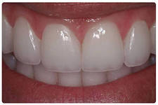 Фасетите на зъбите - какво е това, цената, мнения, коментари, снимки преди и след инсталацията