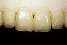 Фасетите на зъбите - какво е това, цената, мнения, коментари, снимки преди и след инсталацията