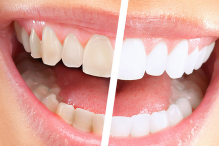 Вредите и ползите от избелване на зъбите - описание, снимки, коментари - тестови покупки